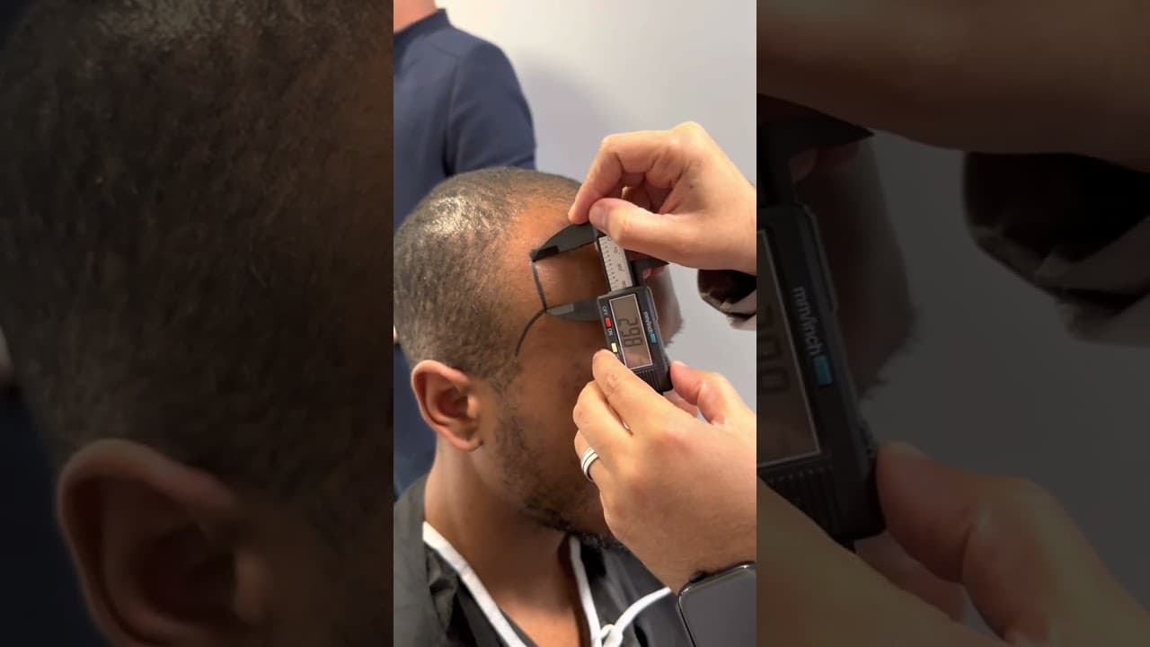 Hair Transplant Consultation by Dr CAYMAZ