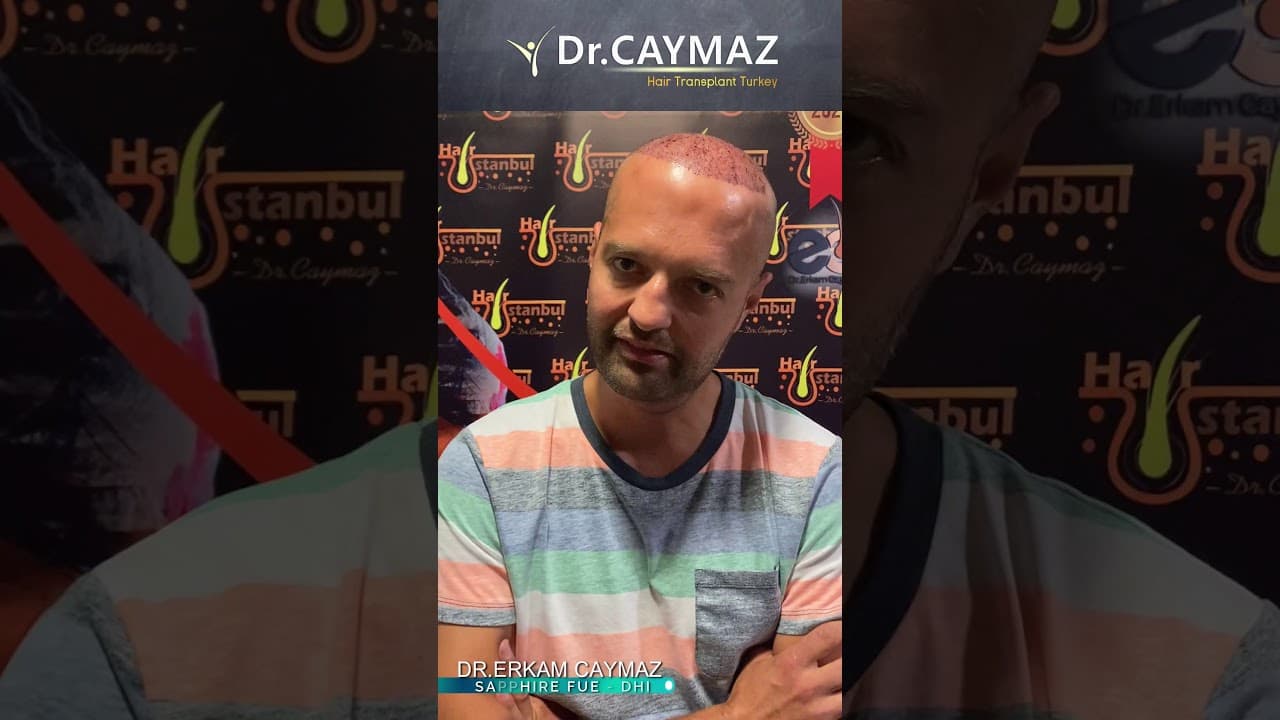 Mr Vedad aus Deutschland - 4000 Graft | Hair Transplant Review