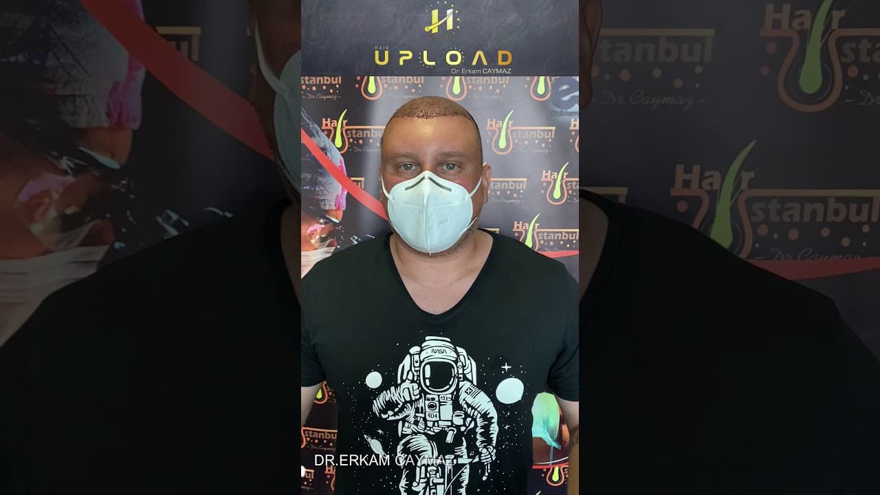 Mr.MICHAEL from USA - 5300 Graft | Hair Transplant Review