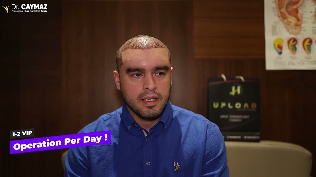 Hair Transplantation From Mr. VILLANUEVA -USA & 3500 GRAFT