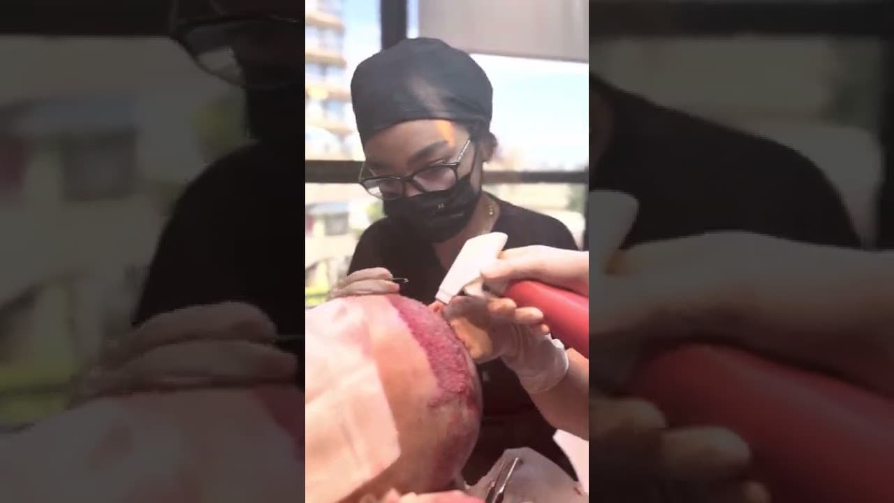 Best Hair Transplant Center in Istanbul Turkey