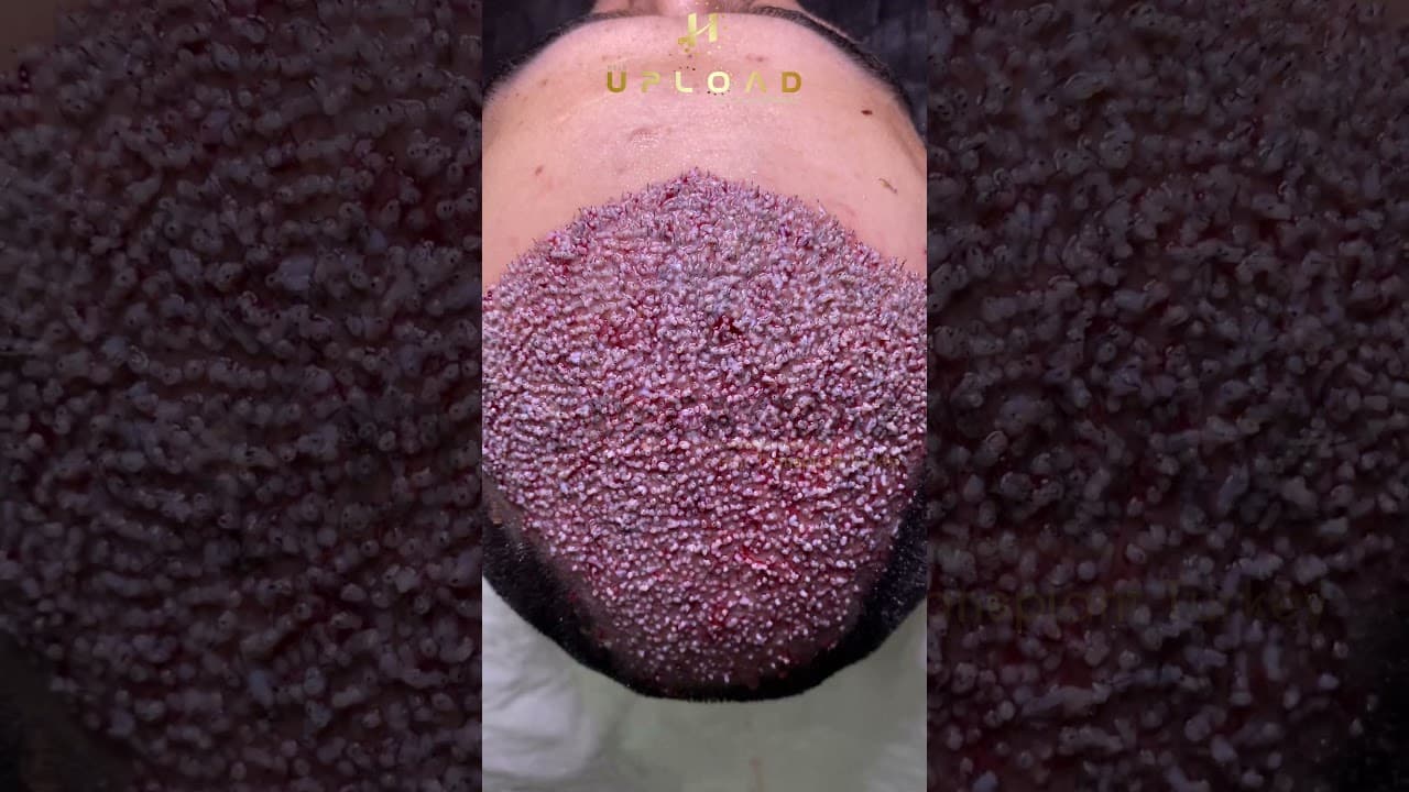 High Density Hair Transplantation by Dr.Erkam CAYMAZ - Sapphire FUE