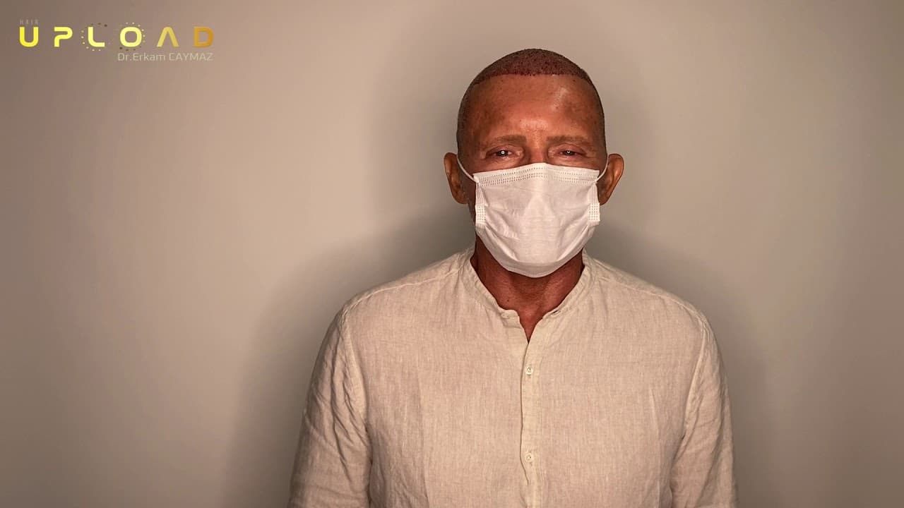 Mr Jorge from Miami,Usa - 5100 Graft | Hair Transplant Review inTurkey Istanbul | Sapphire Fue