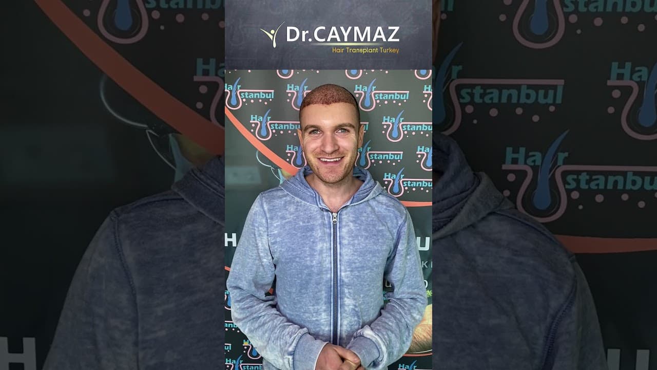 Mr SOHRAB from CANADA - 4650 Graft | Hair Transplant