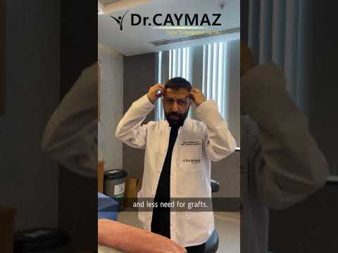 DHI - Direct Hair Implantation | Dr Caymaz - Hair Transplant Turkey