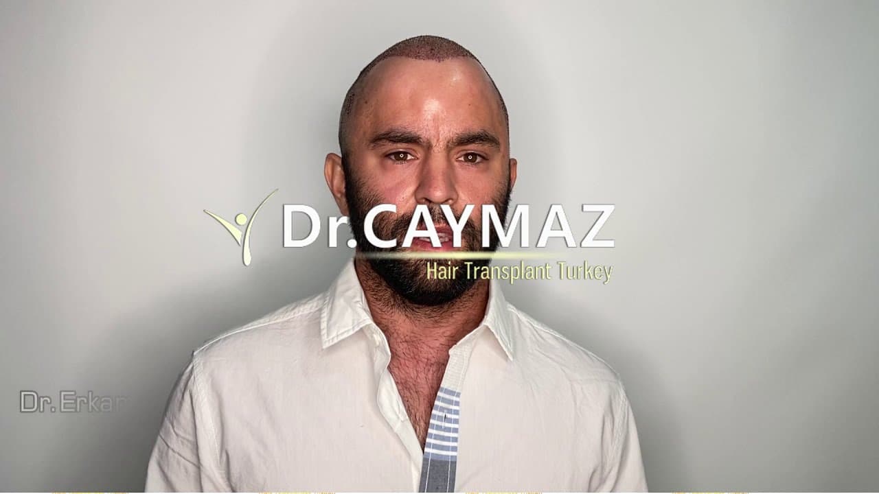 Mr.Drazen - USA - 4900 Graft | Hair Transplant in Turkey Istanbul | Sapphire Fue
