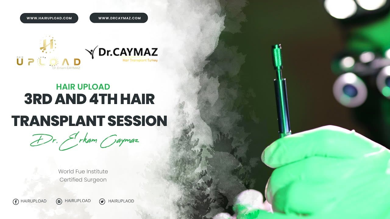 3rd and 4th Hair Transplant Session mp4
