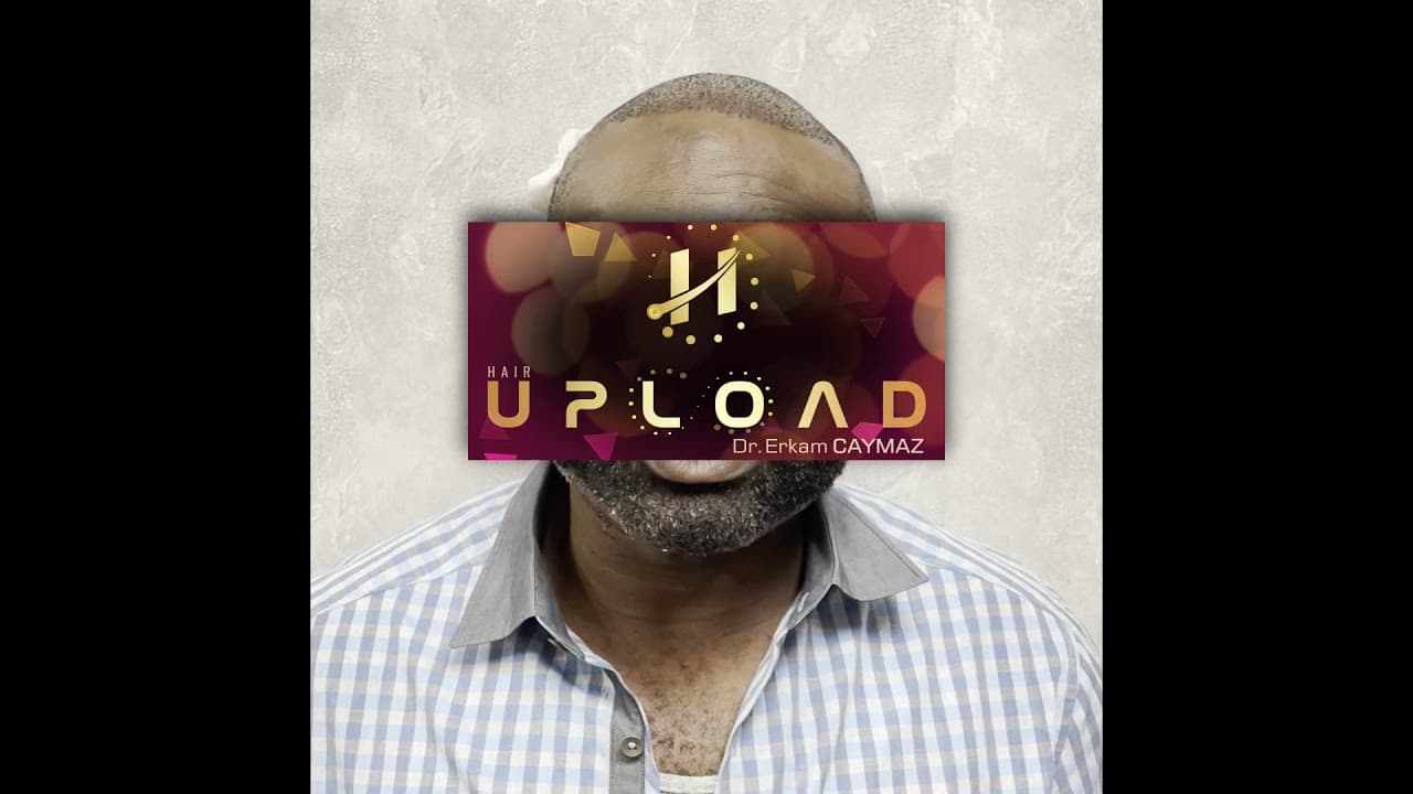 Mr Private - 2500 Graft Sapphire Fue Technique | Dr Erkam CAYMAZ