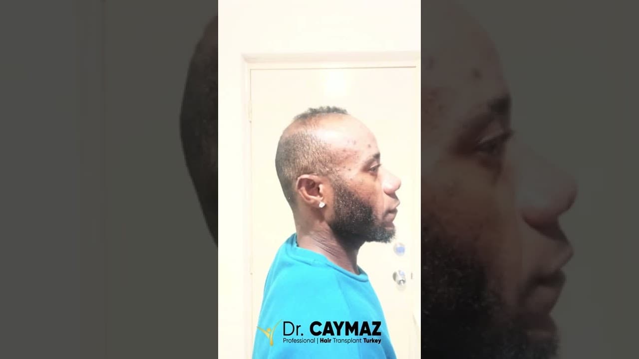 Mr Sieah from Australia - 3200 Graft by Dr CAYMAZ