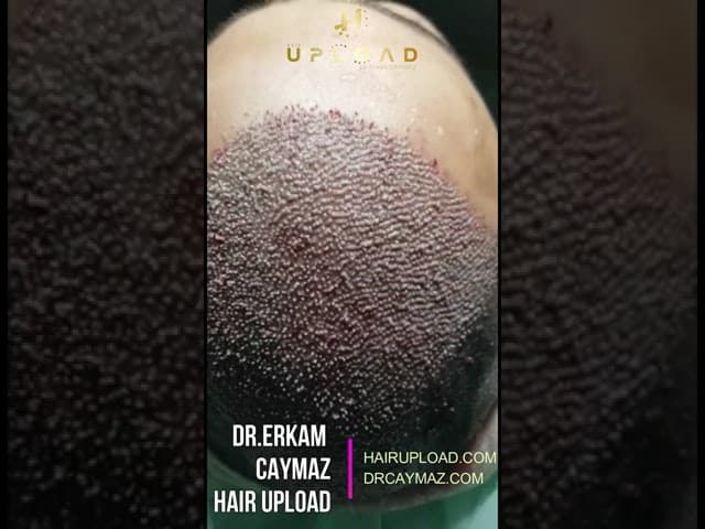 High Density Hair Transplantation