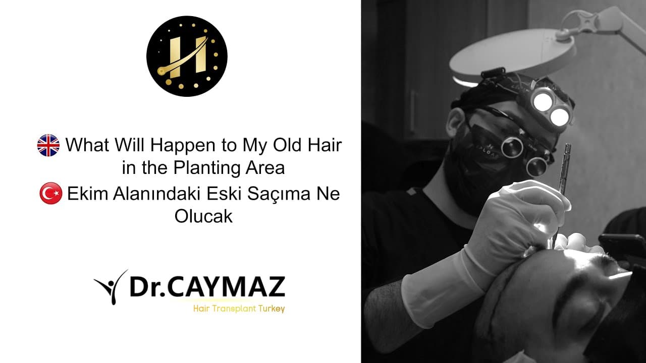 What will Happen to My Existing Hair in the Planting Area? - Dr. Erkam CAYMAZ
