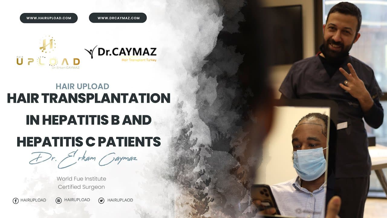 Hair transplantation in hepatitis b and hepatitis c patients