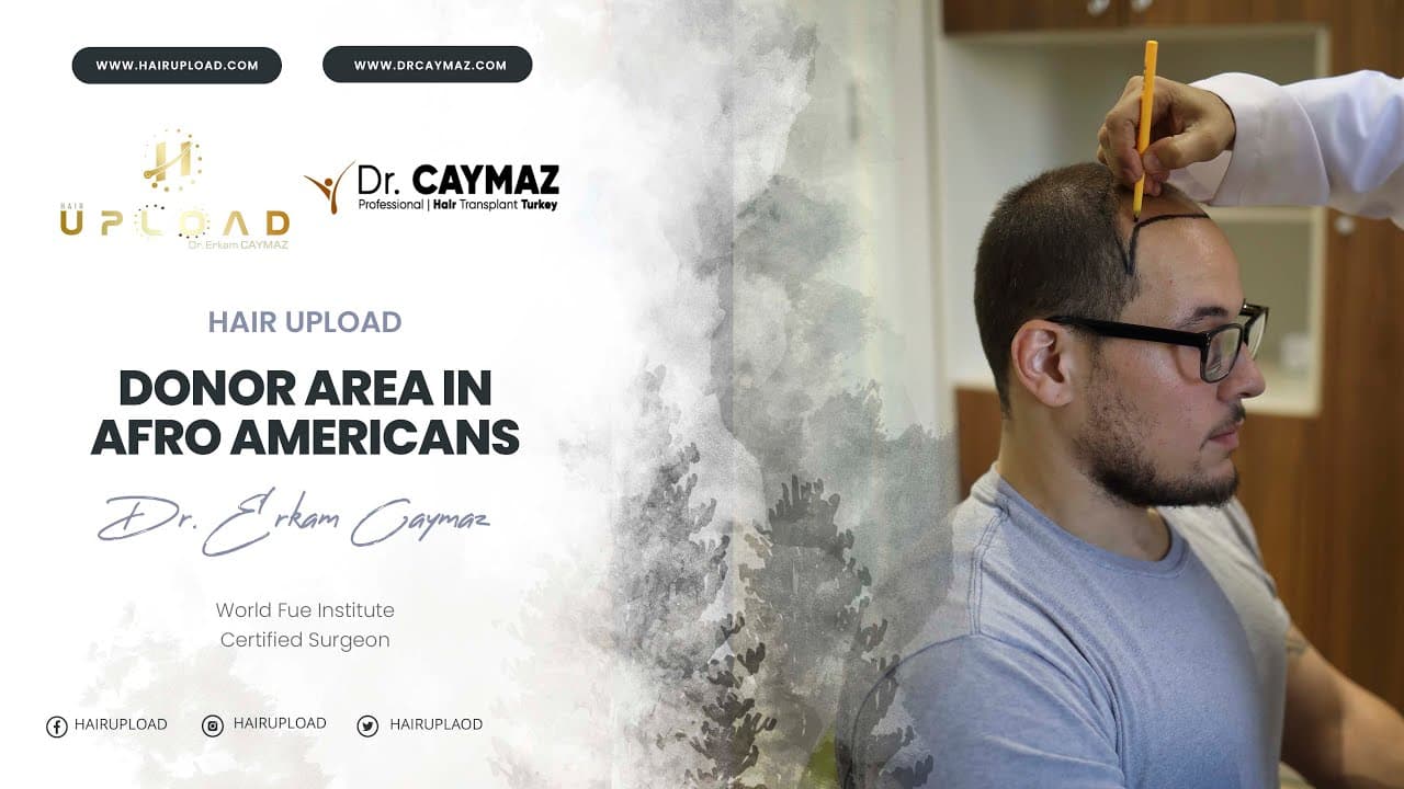 Donor Area in Afro Americans - Hair Transplant Turkey