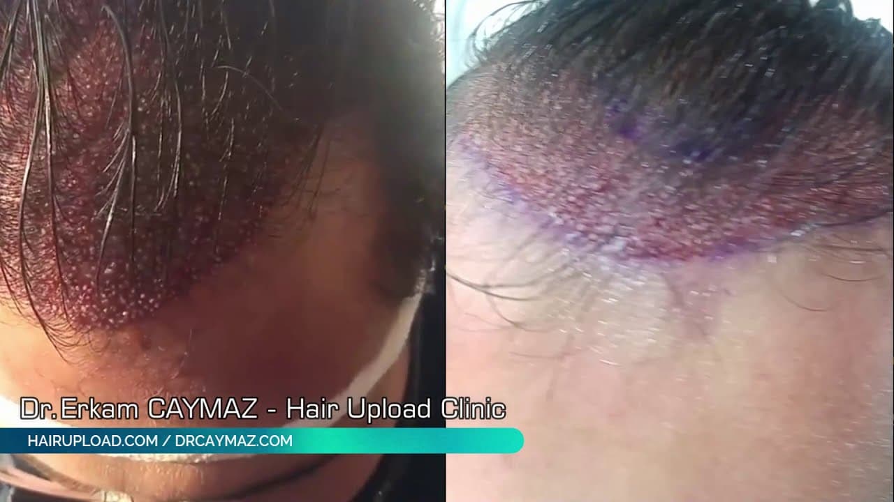 Unshaven Operation - DHI Technique Hair Implantation Turkey