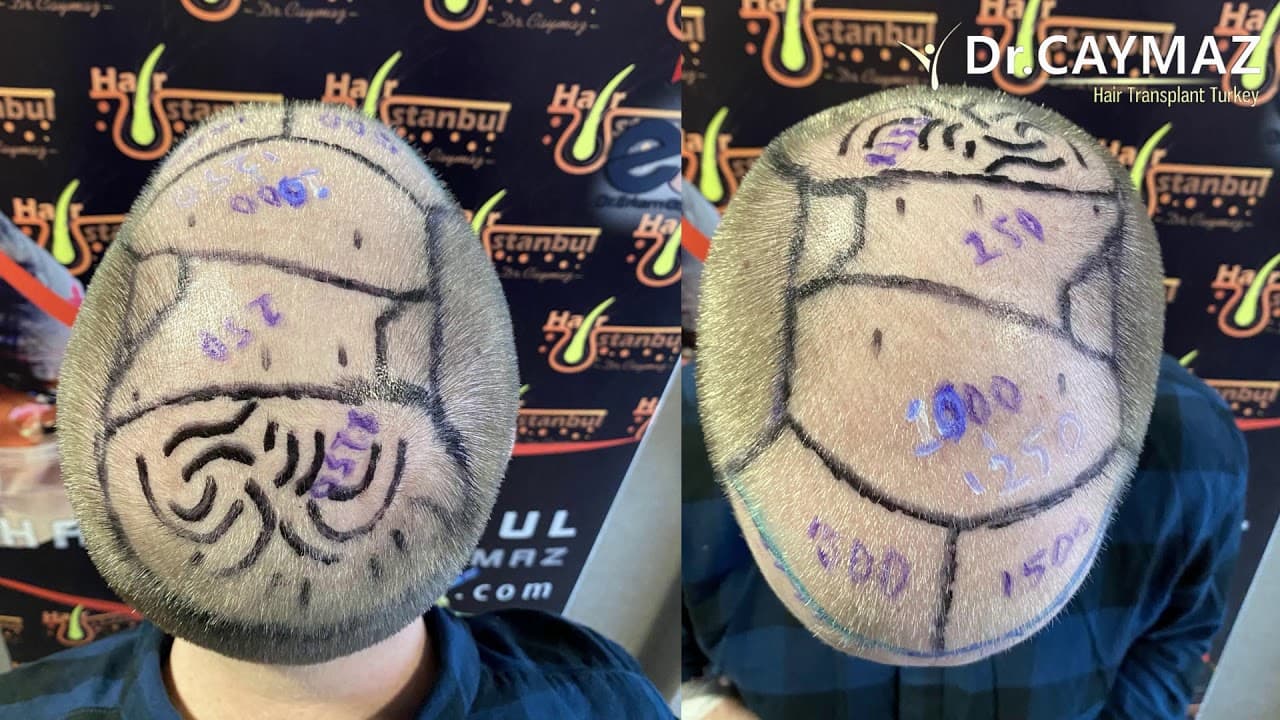 Mr Brandon 5500 Graft Review 5 Months Sapphire Fue Technique