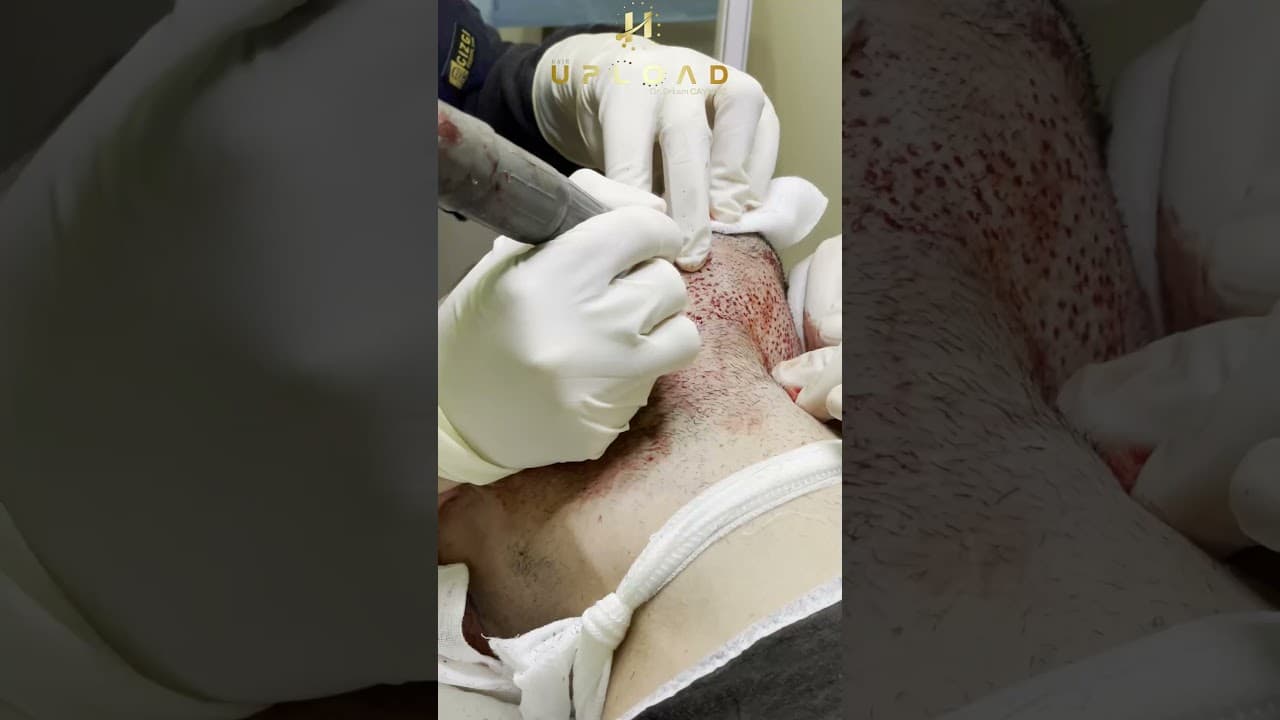 Best Hair Transplantation in Turkey