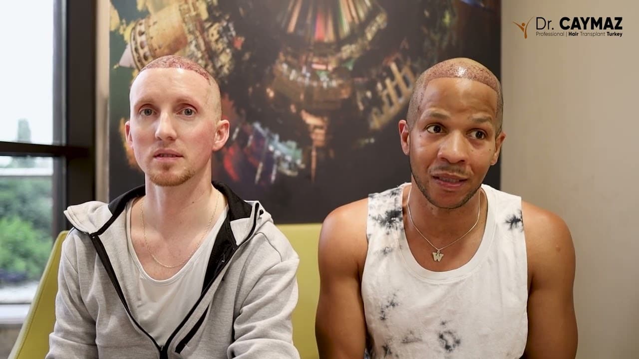 Wilbert LEE WEBB (2500 Graft) and Kurt Daniel LEE (4000 Graft) | Sapphire FUE | USA-Hair Transplant