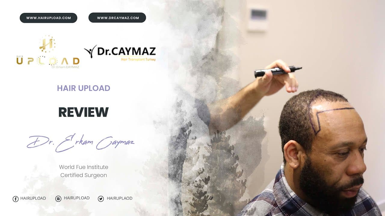 Christopher Sieh - 3200 Graft | Hair Transplant Review | Australia