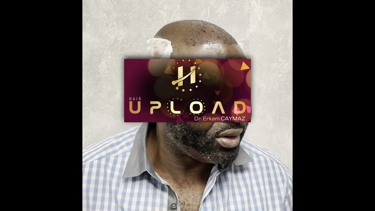 Mr Private 2500 Graft Sapphire Fue Technique