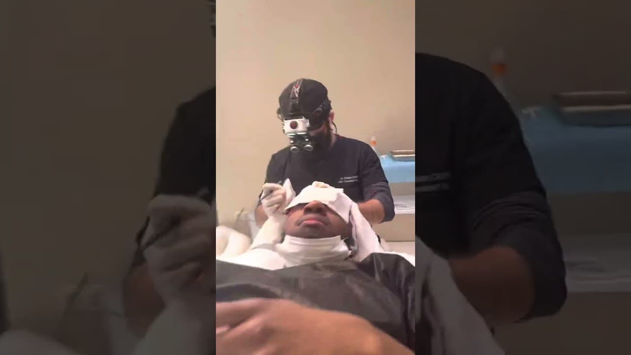 Afro-American Hair Transplantation