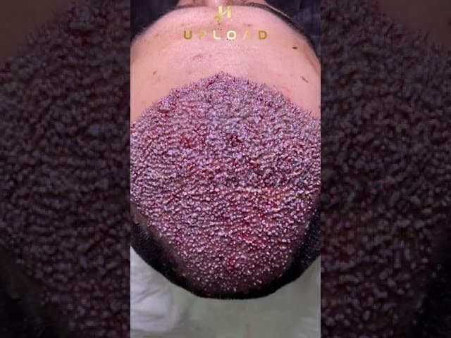 High Density Hair Transplantation