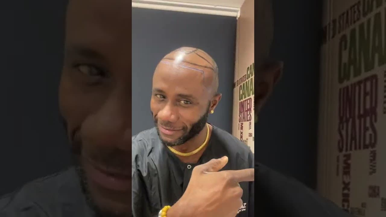 Mr Christopher - Hair Transplant review