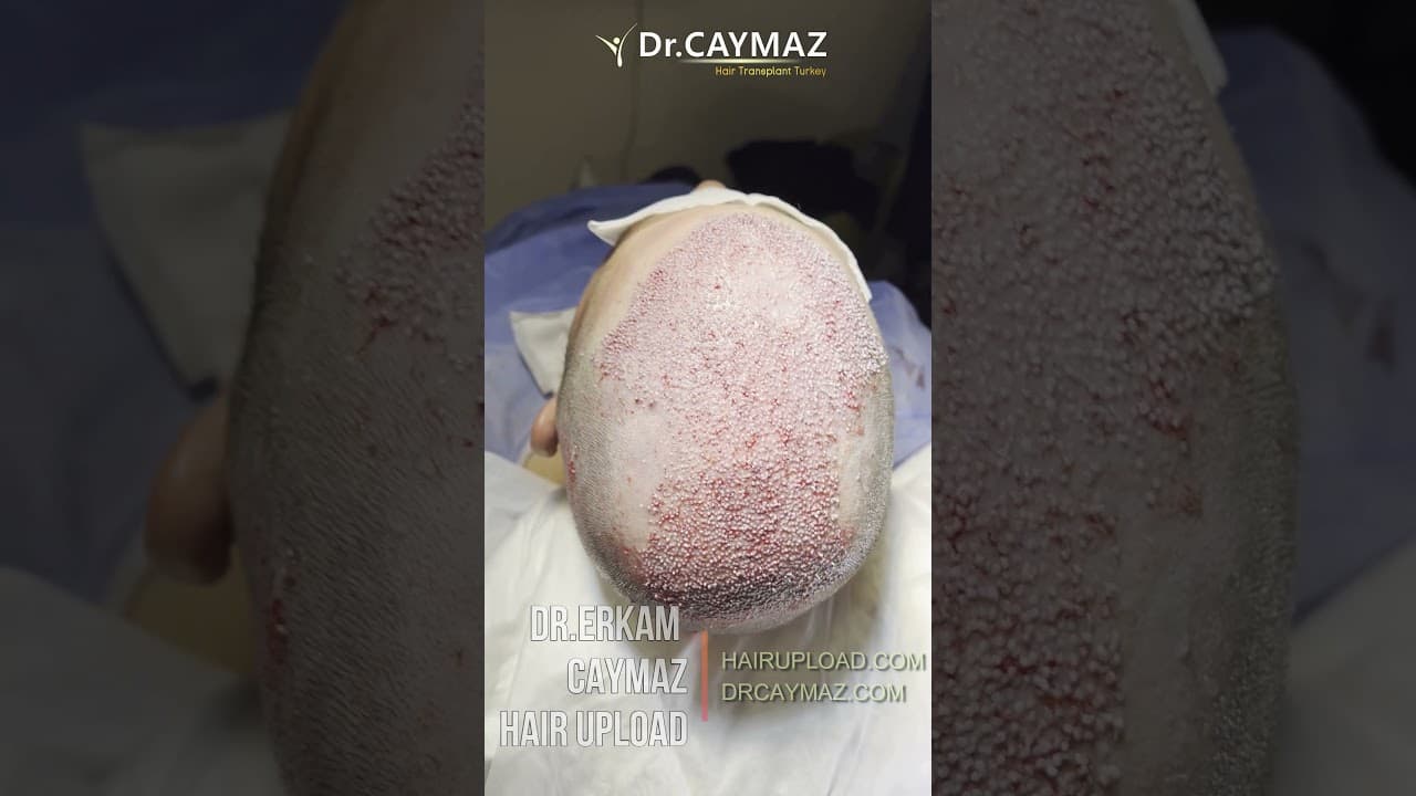 Density of Hair Implantation