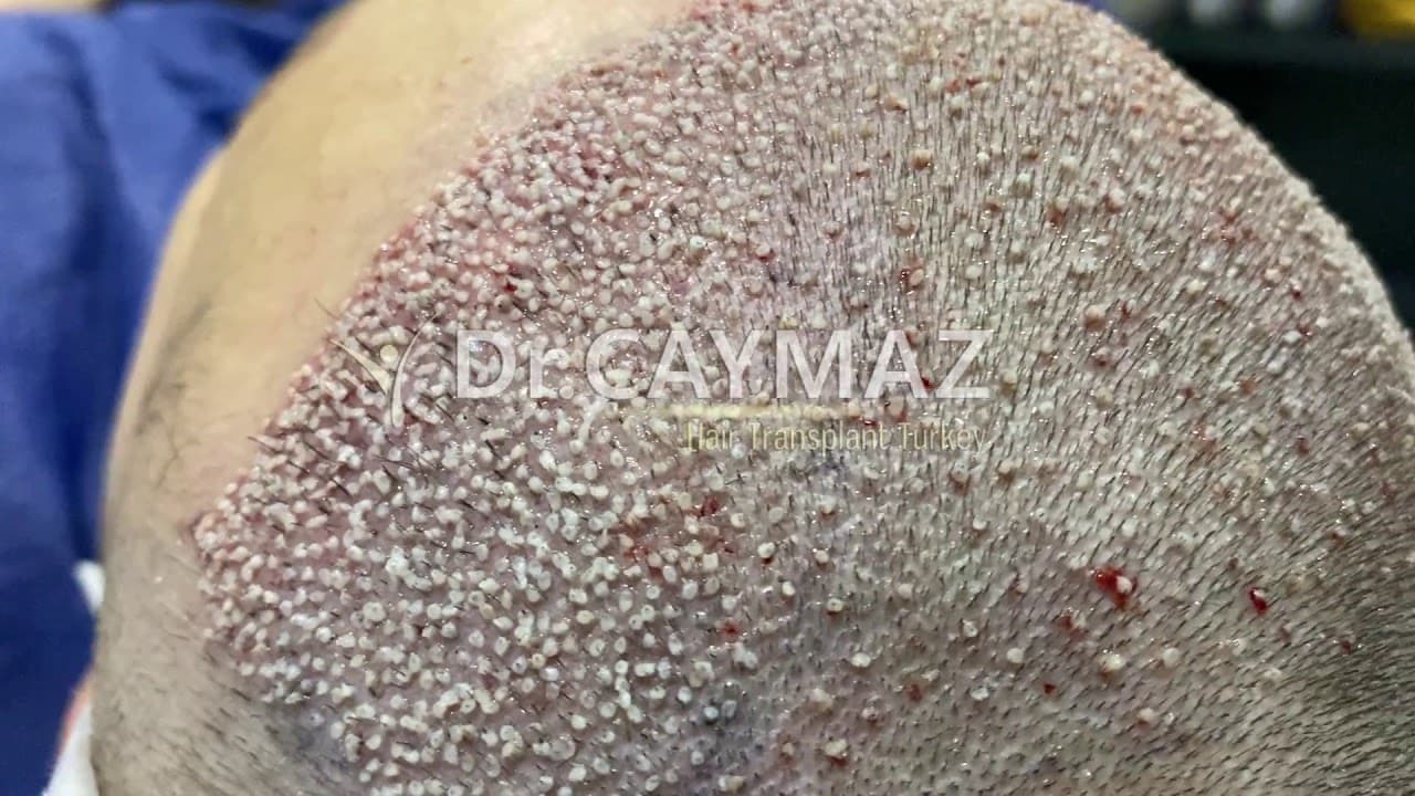 High Density Hair Transplantation
